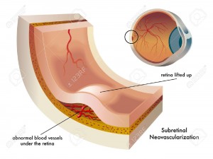 Subretinal Neovascularization Stock Vector- Retina Ophthalmologist in Frederick MD