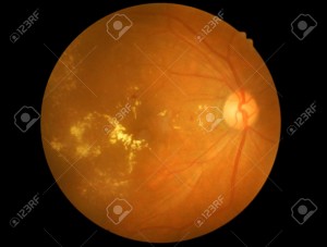 Retina Ophthalmology Gettysburg PA & Frederick MD