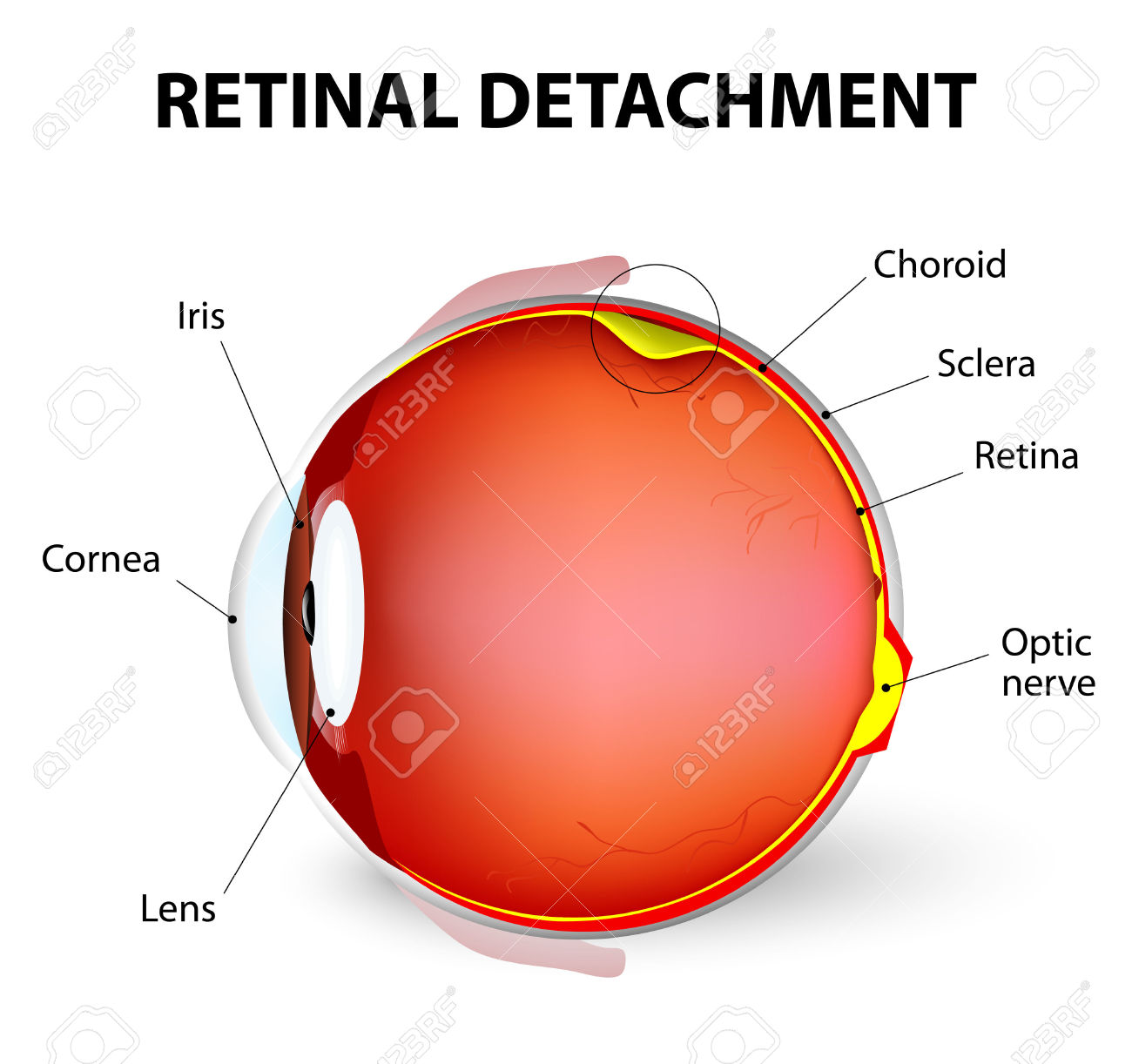 abnormal Amsler Grid test- Retina Ophthalmology Gettysburg PA & Frederick  MD - Greater Potomac Retina - Greater Potomac Retina