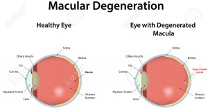 Healthy Eye vs Eye with Macular Degeneration- Retina Ophthalmology in Frederick MD